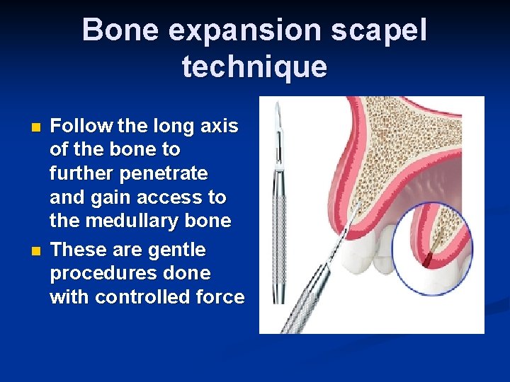 Bone expansion scapel technique n n Follow the long axis of the bone to