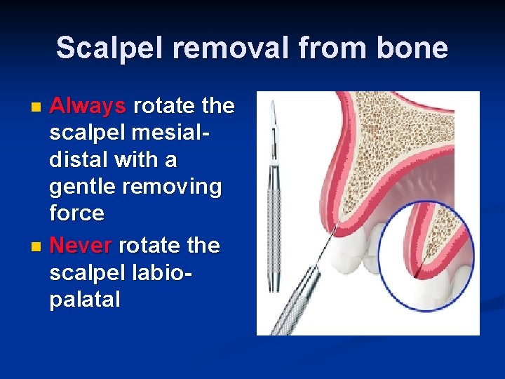 Scalpel removal from bone Always rotate the scalpel mesialdistal with a gentle removing force