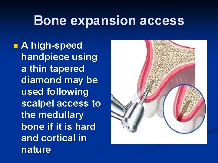 Bone expansion access n A high-speed handpiece using a thin tapered diamond may be