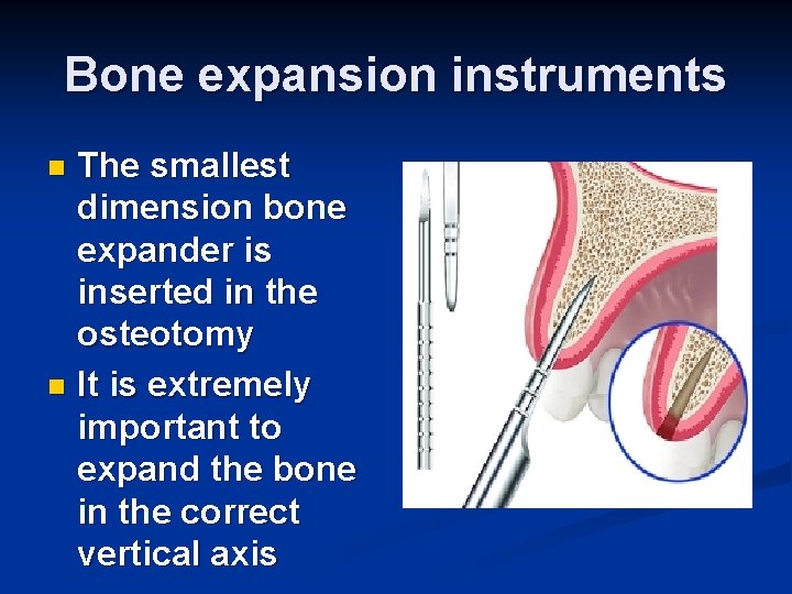 Bone expansion instruments The smallest dimension bone expander is inserted in the osteotomy n