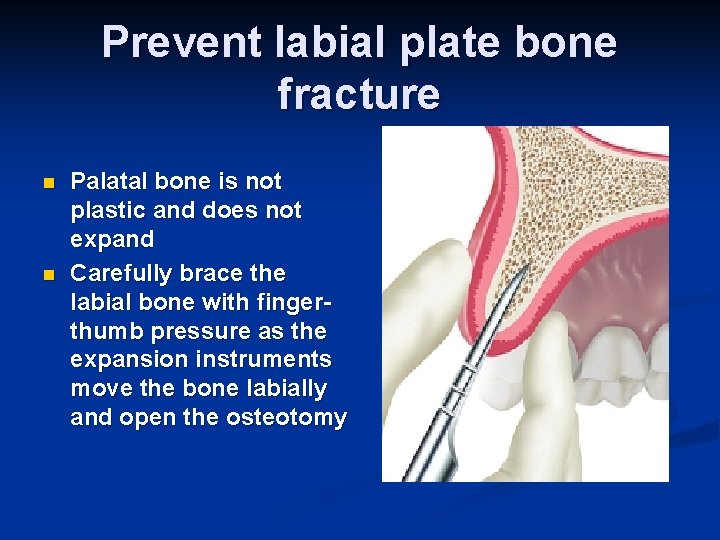 Prevent labial plate bone fracture n n Palatal bone is not plastic and does