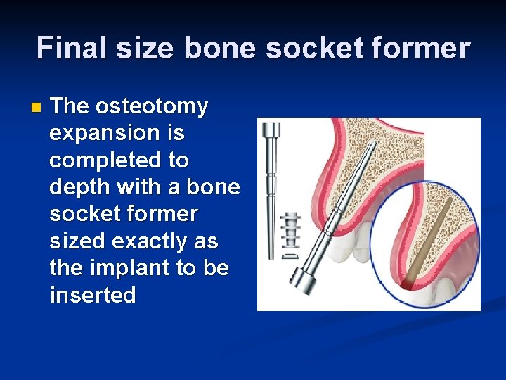 Final size bone socket former n The osteotomy expansion is completed to depth with