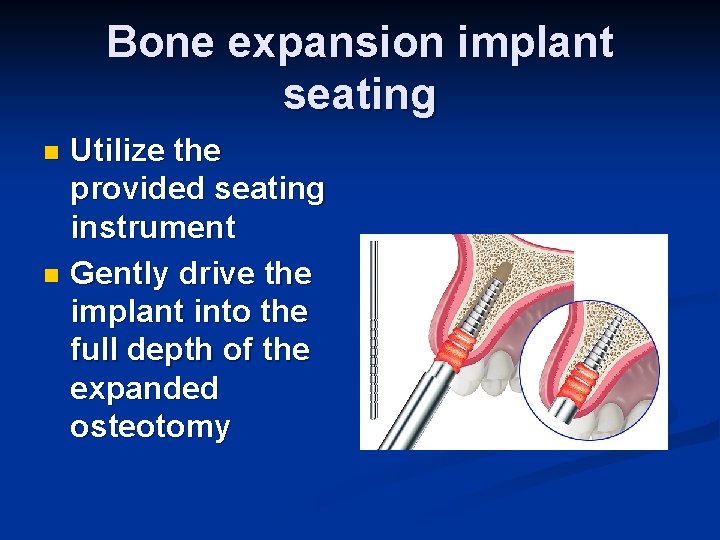 Bone expansion implant seating Utilize the provided seating instrument n Gently drive the implant