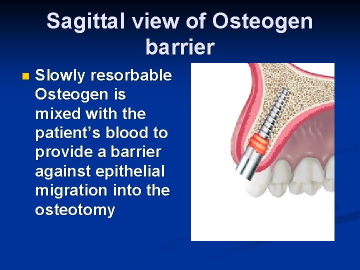 Sagittal view of Osteogen barrier n Slowly resorbable Osteogen is mixed with the patient’s