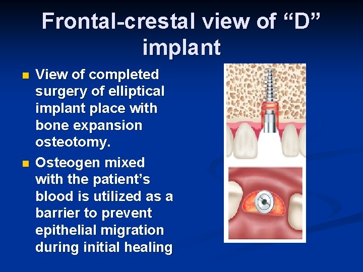 Frontal-crestal view of “D” implant n n View of completed surgery of elliptical implant