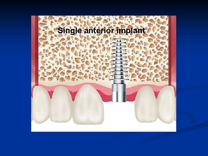 Single anterior implant Single anterior 