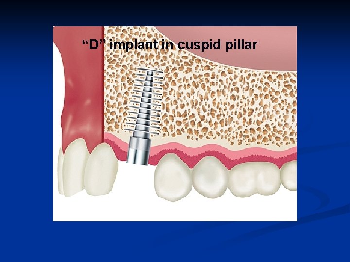 “D” implant in cuspid pillar 