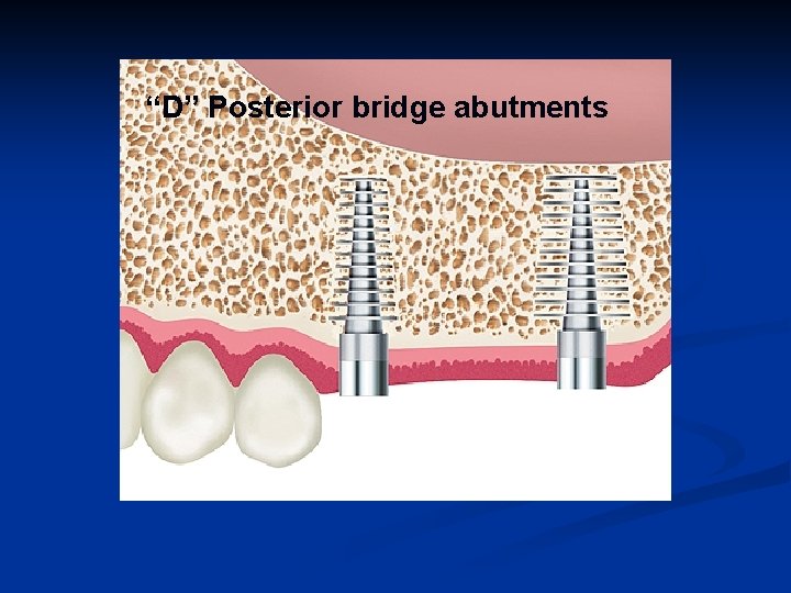 “D” Posterior bridge abutments 
