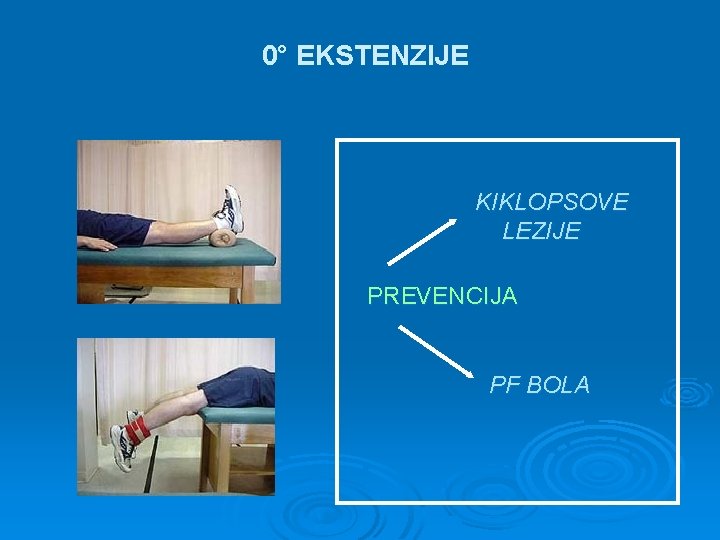 0° EKSTENZIJE KIKLOPSOVE LEZIJE PREVENCIJA PF BOLA 