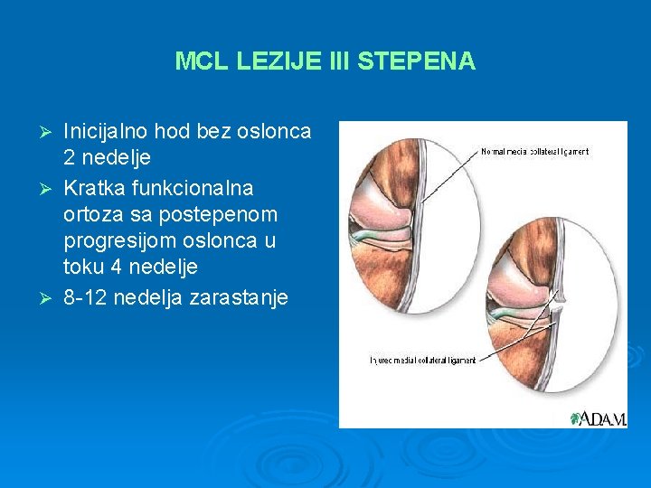 MCL LEZIJE III STEPENA Inicijalno hod bez oslonca 2 nedelje Ø Kratka funkcionalna ortoza