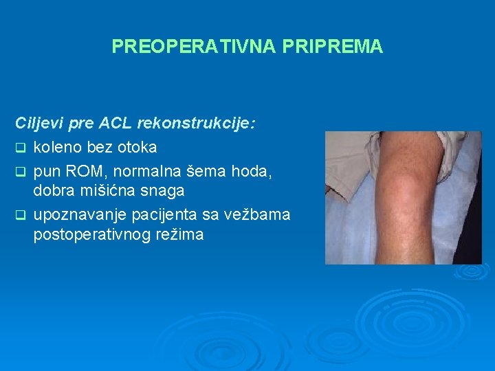 PREOPERATIVNA PRIPREMA Ciljevi pre ACL rekonstrukcije: q koleno bez otoka q pun ROM, normalna