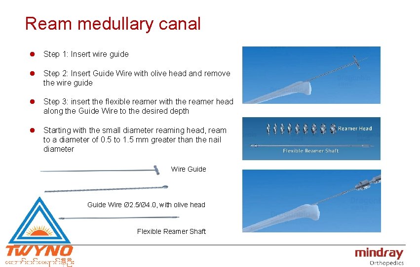 Ream medullary canal l Step 1: Insert wire guide l Step 2: Insert Guide