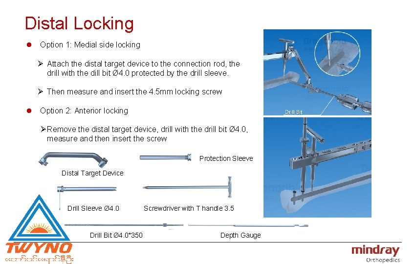 Distal Locking l Option 1: Medial side locking Ø Attach the distal target device
