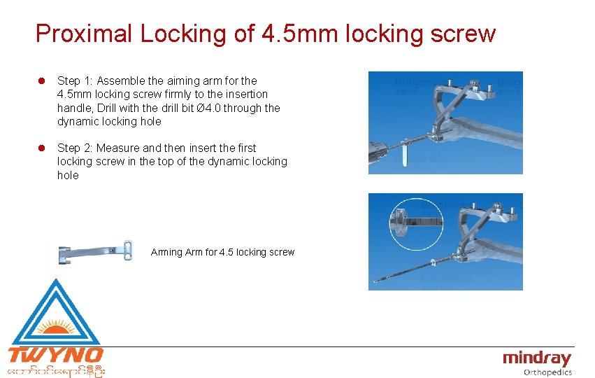 Proximal Locking of 4. 5 mm locking screw l Step 1: Assemble the aiming