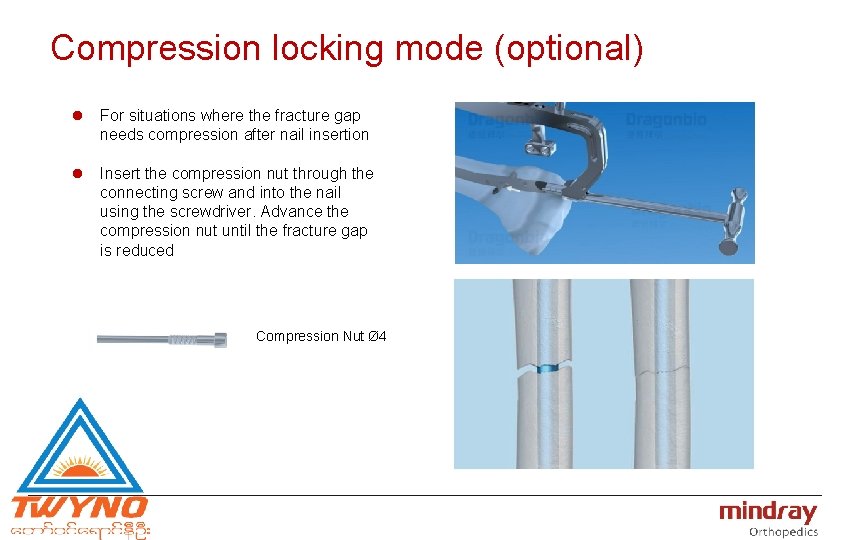 Compression locking mode (optional) l For situations where the fracture gap needs compression after