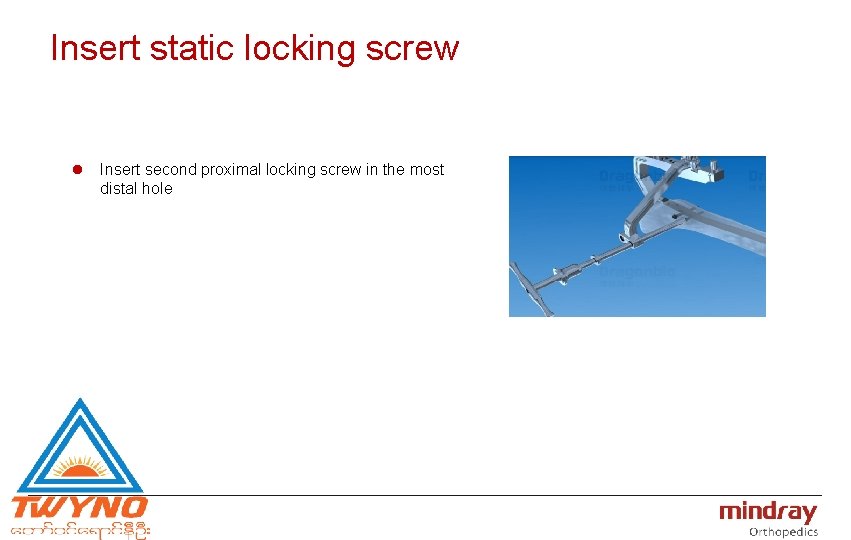 Insert static locking screw l Insert second proximal locking screw in the most distal