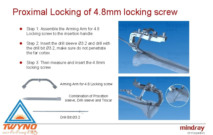 Proximal Locking of 4. 8 mm locking screw l Step 1: Assemble the Arming