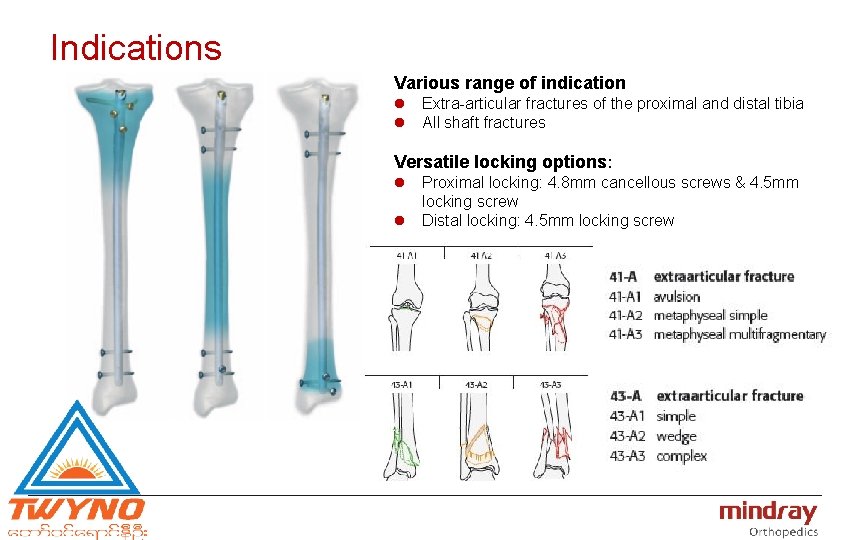 Indications Various range of indication l Extra-articular fractures of the proximal and distal tibia