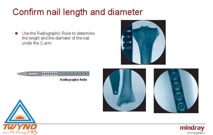 Confirm nail length and diameter l Use the Radiographic Ruler to determine the length
