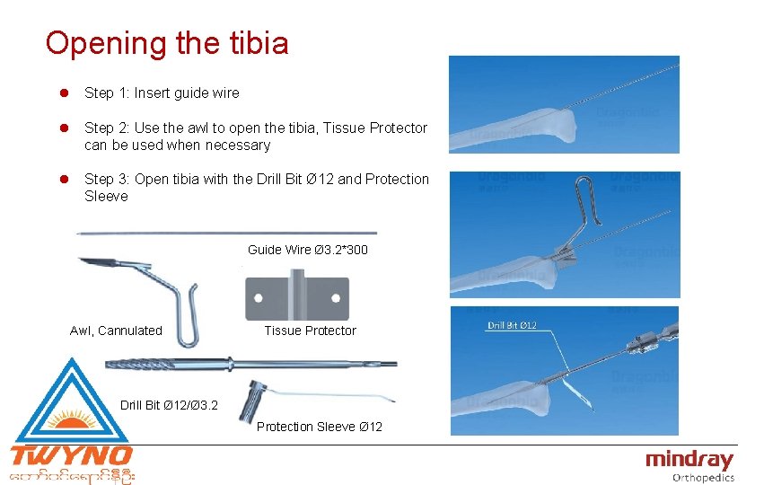 Opening the tibia l Step 1: Insert guide wire l Step 2: Use the