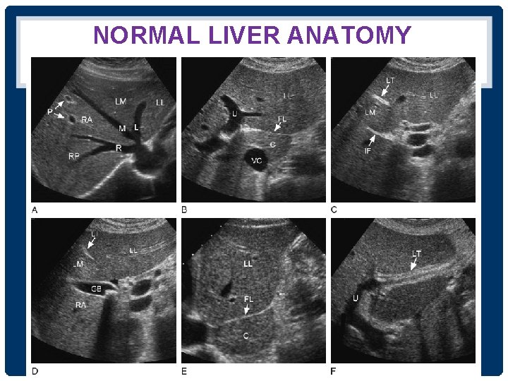 NORMAL LIVER ANATOMY 