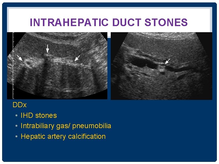 INTRAHEPATIC DUCT STONES DDx • IHD stones • Intrabiliary gas/ pneumobilia • Hepatic artery
