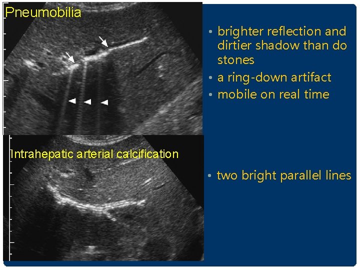 Pneumobilia • brighter reflection and dirtier shadow than do stones • a ring-down artifact