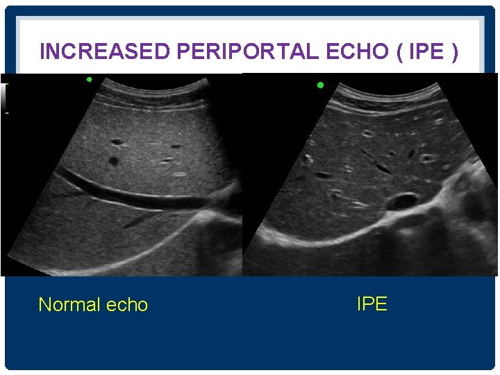 INCREASED PERIPORTAL ECHO ( IPE ) Normal echo IPE 