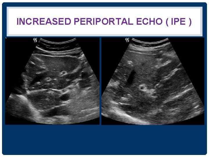 INCREASED PERIPORTAL ECHO ( IPE ) 