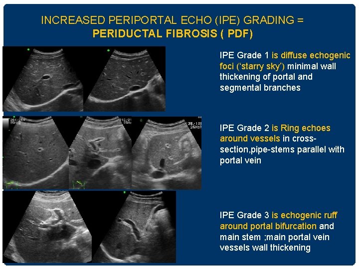 INCREASED PERIPORTAL ECHO (IPE) GRADING = PERIDUCTAL FIBROSIS ( PDF) IPE Grade 1 is