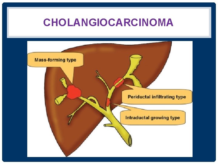 CHOLANGIOCARCINOMA 