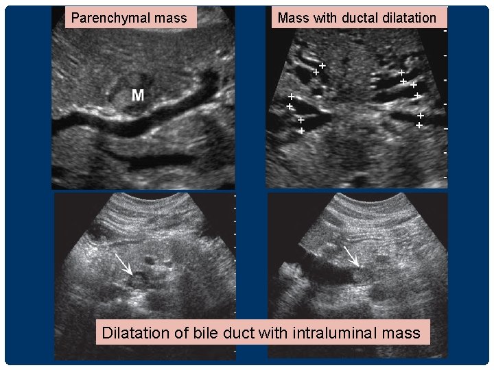 Parenchymal mass Mass with ductal dilatation Dilatation of bile duct with intraluminal mass 