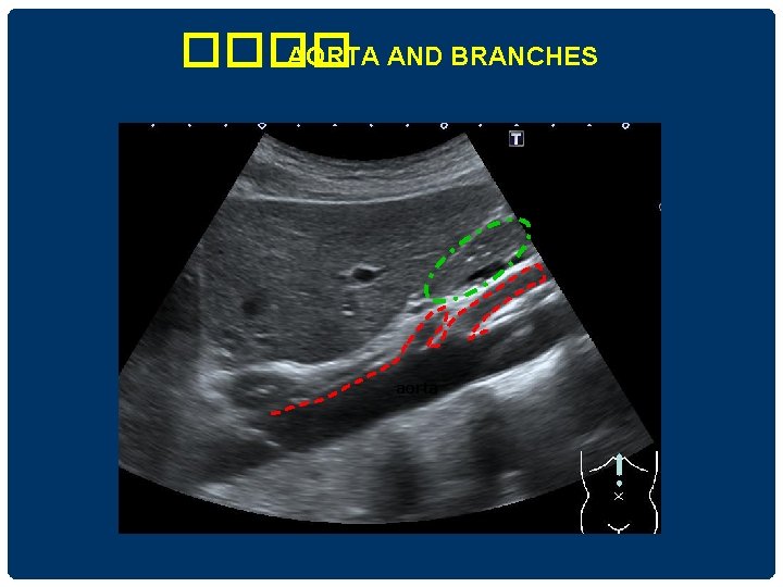 ���� AORTA AND BRANCHES aorta 