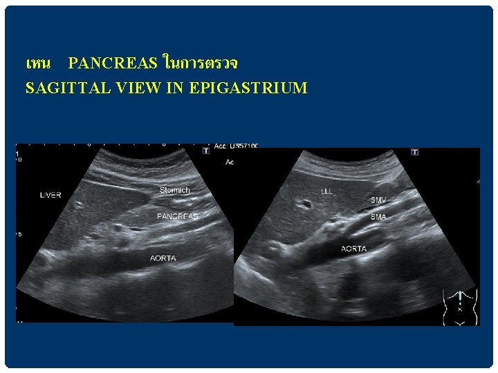 เหน PANCREAS ในการตรวจ SAGITTAL VIEW IN EPIGASTRIUM 