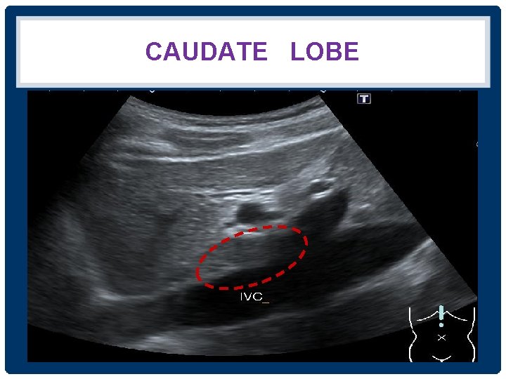CAUDATE LOBE IVC 