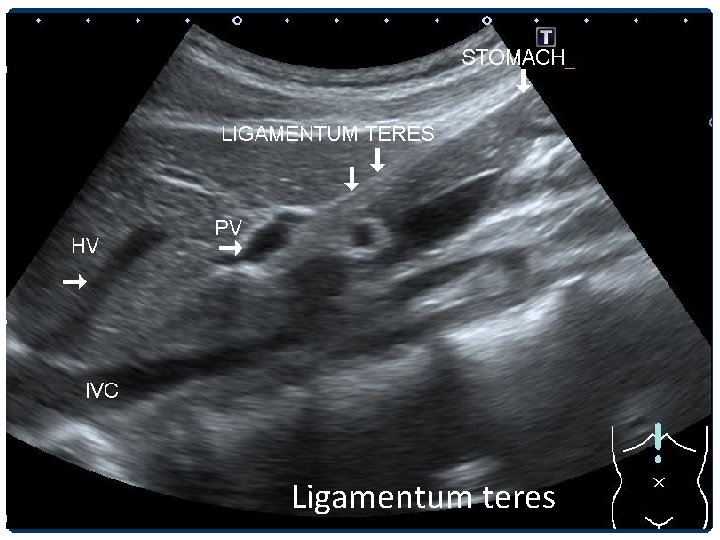 Ligamentum teres 