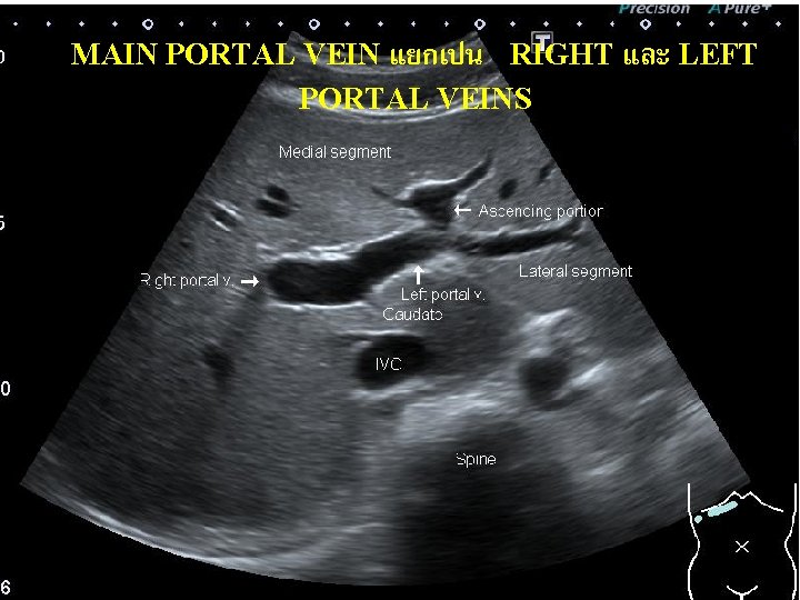 MAIN PORTAL VEIN แยกเปน RIGHT และ LEFT PORTAL VEINS 