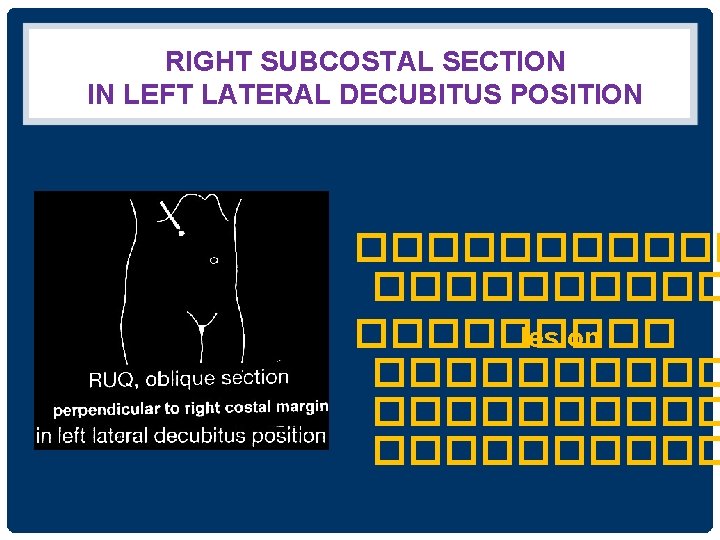 RIGHT SUBCOSTAL SECTION IN LEFT LATERAL DECUBITUS POSITION ��������� lesion ���������� 