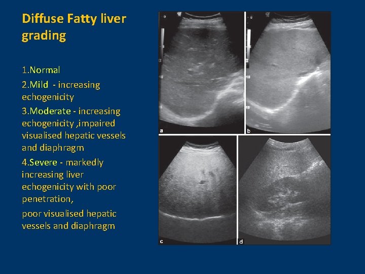 Diffuse Fatty liver grading 1. Normal 2. Mild - increasing echogenicity 3. Moderate -