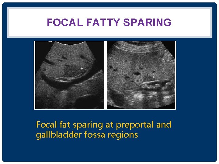 FOCAL FATTY SPARING Focal fat sparing at preportal and gallbladder fossa regions 