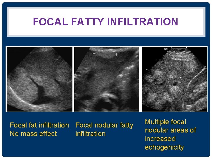 FOCAL FATTY INFILTRATION Focal fat infiltration Focal nodular fatty No mass effect infiltration Multiple