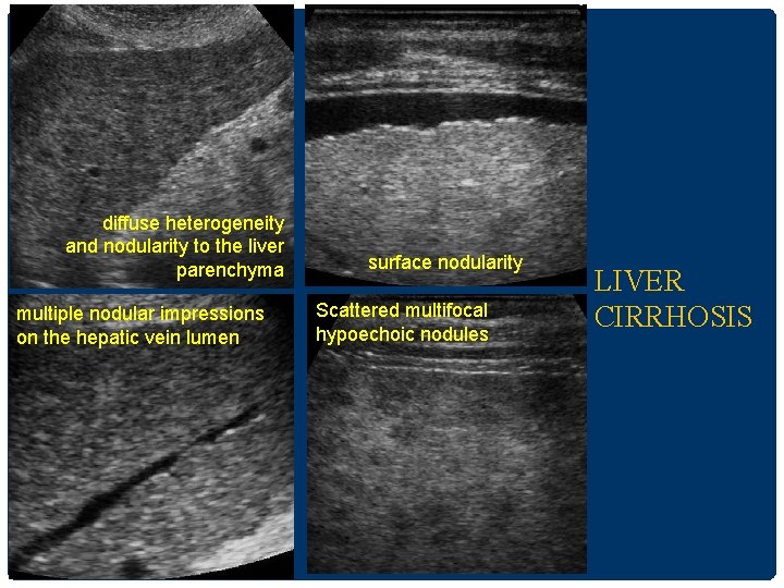 diffuse heterogeneity and nodularity to the liver parenchyma multiple nodular impressions on the hepatic