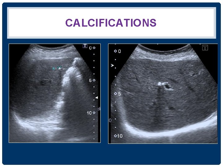 CALCIFICATIONS 