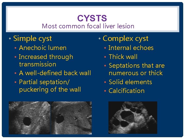 CYSTS Most common focal liver lesion • Simple cyst • Anechoic lumen • Increased