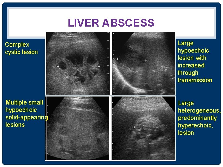 LIVER ABSCESS Complex cystic lesion Large hypoechoic lesion with increased through transmission Multiple small