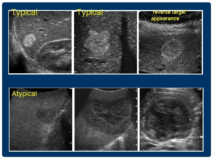 Typical Atypical Typical “reverse target” appearance 