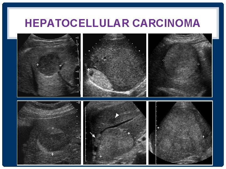 HEPATOCELLULAR CARCINOMA 