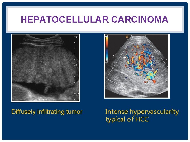 HEPATOCELLULAR CARCINOMA Diffusely infiltrating tumor Intense hypervascularity typical of HCC 