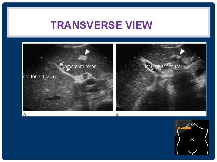 TRANSVERSE VIEW ligamentum teres interlobar fissure 