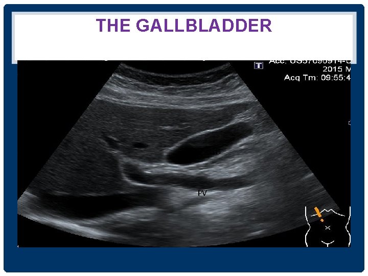 THE GALLBLADDER GB PV 